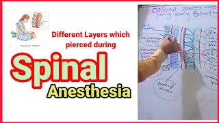 Layers which pierced during spinal anesthesia anaesthesiawithbabar2576 [upl. by Htiekram]