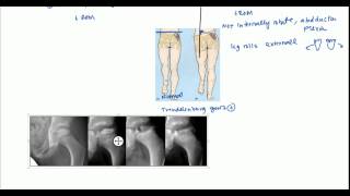 Legg Calves Perthes LCP and Slipped Capital Femoral Epiphysis for USMLE [upl. by Saber]