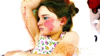 WE FOUND HER WITH MACULOPAPULAR RASH SHOCKING [upl. by Arahsat]