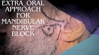 Extraoral Technique for Mandibular Nerve Block [upl. by Corine]