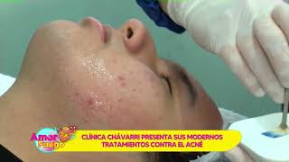 Limpieza facial para Combatir el Acné  Clínica Chávarri [upl. by Noiwtna]