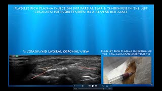 Ultrasound Guided Platelet Rich Plasma Injection for Lateral EpicondylitisPartial Tear [upl. by Melisande463]