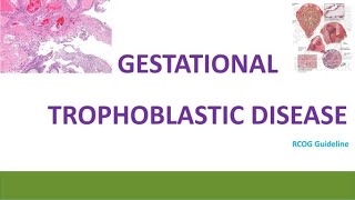 Gestational Trophoblastic Disease RCOG Guideline [upl. by Eelyak]