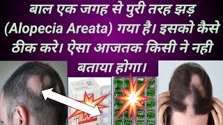 Alopeciaareataबाल एक जगह से पुरी तरह झड़Alopecia Areataगया है। कैसे ठीक करे।Abhia2zmedical [upl. by Amlez]