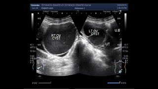 Ultrasound Video showing the difference between Simple Ovarian Cyst and Hemorrhagic Ovarian Cyst [upl. by Ralip439]