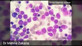 Acute Myeloid Leukemia AML M3 [upl. by Charleen]