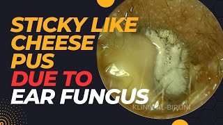 STICKY Like Cheese Pus Due To Ear Fungus [upl. by Jedthus]