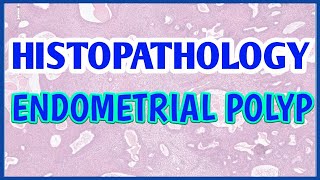 ENDOMETRIAL POLYP  HISTOPATHOLOGY  PathTube [upl. by Mccarthy963]