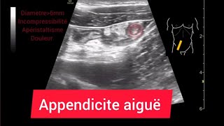 Appendicite aiguë Epanchement Adénopathies mésentériques Échographie Appendicitis [upl. by Legge]