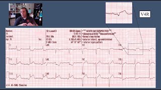 Acute Coronary Syndromes STEMI Recognition STEMI Mimics [upl. by Eikcid]