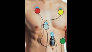 Holter monitoring II noninvasive procedure II cardiovascular disease II nursing II medical study II [upl. by Nigrom538]