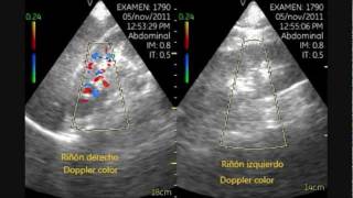 VSCAN Left renal infarction Pocket ultrasound bedside [upl. by Norrehs]