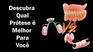 Prótese Dentária Removível  Conheça os 3 Tipos que Existem Para Substituir Dentes Perdidos [upl. by Rakel]