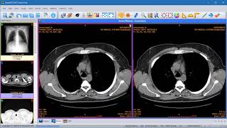 Sante DICOM Viewer  How to compare images of the same series [upl. by Torbart]