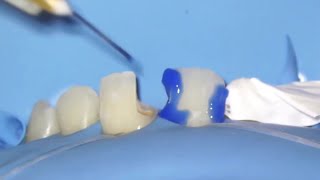 anterior Composite Restoration  Class III amp IV Composite Restoration [upl. by Doner73]