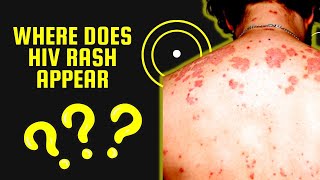 Where does HIV Rash Appear   Skin Conditions Associated with HIV [upl. by Ottie]