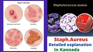 Staphylococcus aureus in ಕನ್ನಡ Systemic Bacteriology [upl. by Cissie250]