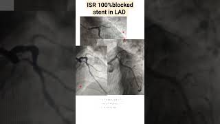 ISR instent restenosis l 100 blocked stent in LAD l Repeat Stenting done to LAD shorts [upl. by Dixie]