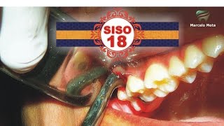 EXTRAÇÃO DE SISO 18  wisdom tooth Extraction Surgery [upl. by Noemys806]