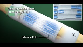 Nerve Repair with NeuraGen Nerve Guide from Integra Life Sciences  Ghost Medical [upl. by Hseyaj]