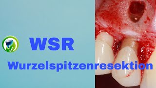 Die Wurzelspitzenresektion  WSR  retrograde Wurzelfüllung Schnittführung Zahnerhaltung [upl. by Orfield]