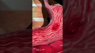 What Can Cause Stomach Ulcers Animation [upl. by Treblihp193]