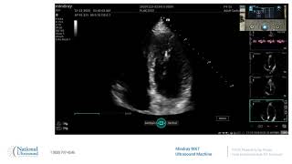 How to Use the Auto EF Function on the Mindray MX7 Ultrasound Machine [upl. by Gobert]