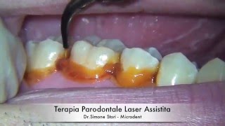 Terapia Parodontale Laser Assistita [upl. by Prober23]