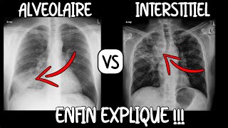 Médecine  Tout savoir sur la radiographie de thorax [upl. by Akemhs]