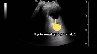 Kyste rénal Type Bosniak 2 Échographie [upl. by Eimmot669]