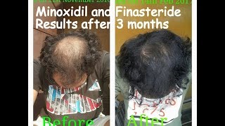 Minoxidil and Finasteride Results after 3 Months Usage [upl. by Otilrac]