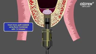 Internal Sinus Lift [upl. by Ainerol358]