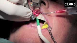 Dental Training  Implant surgery [upl. by Dnumyar319]