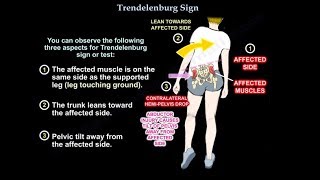 Trendelenburg Sign  Everything You Need To Know  Dr Nabil Ebraheim [upl. by Decca271]