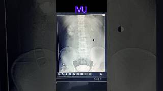 Intra venous urogram  pyelogram  radiological xray medicalimaging doctor anatomy [upl. by Sahc229]