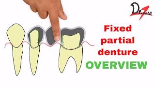 Fixed partial denture  Overview ENGLISH [upl. by Nad]