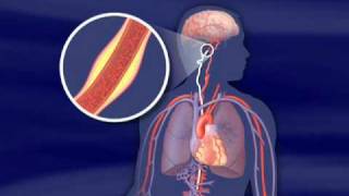 Mechanical Thrombectomy in stroke medicine anatomy science health stroke [upl. by Llertniuq887]