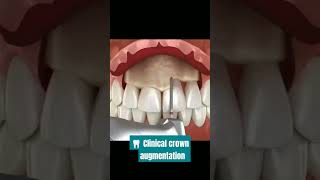 🦷 Clinical crown augmentation [upl. by Nomzzaj]