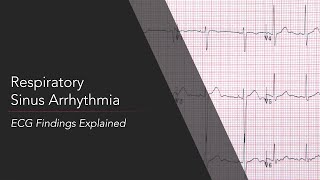 Respiratory Sinus Arrhythmia ECG [upl. by Teressa]