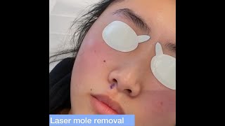 Laser Mole Removal  London Skin Clinic [upl. by Dysart]