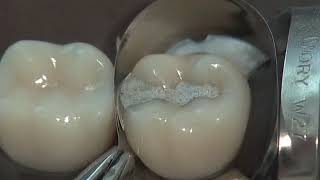 Class II Amalgam Preparation amp Restoration  Operative Dentistry [upl. by Maurice]