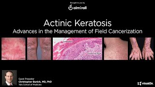 Seborrheic Keratosis  Daily Dos of Dermatology [upl. by Asenaj]