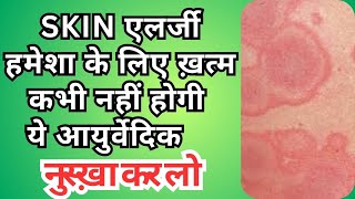 स्किन एलर्जी का घरेलू नुस्खा How To Cure Skin Allergy skin allergy treatment at home Dr Dharam Pal [upl. by Aisya]