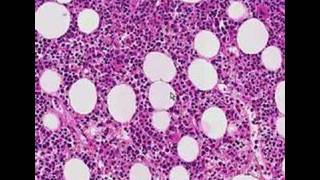 Histopathology Bone marrow Follicular lymphoma [upl. by Arakal]