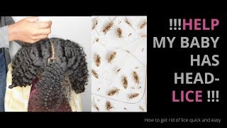 How to Remove Head Lice Eggs  Nit and Lice Picking [upl. by Oniotna601]