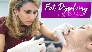 Double Chin Fat Dissolving Treatment  NonSurgical Liposuction [upl. by Kippie]