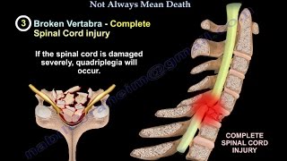 Cervical spine fractureneck fracture  Everything You Need To Know  Dr Nabil Ebraheim [upl. by Aened902]