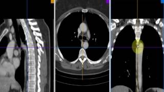 Radiologia Para Estudiantes TC de mediastino [upl. by Ardy571]