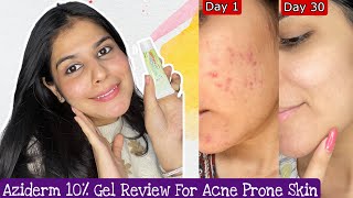 How To Treat Acne Scars  Aziderm 10 Cream Review [upl. by Gnel542]