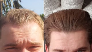 Finasteride Peak Results Compared To Minoxidil Hair Growth [upl. by Melamed311]